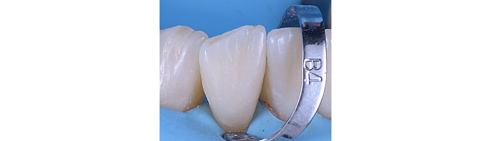 Close up of veneer