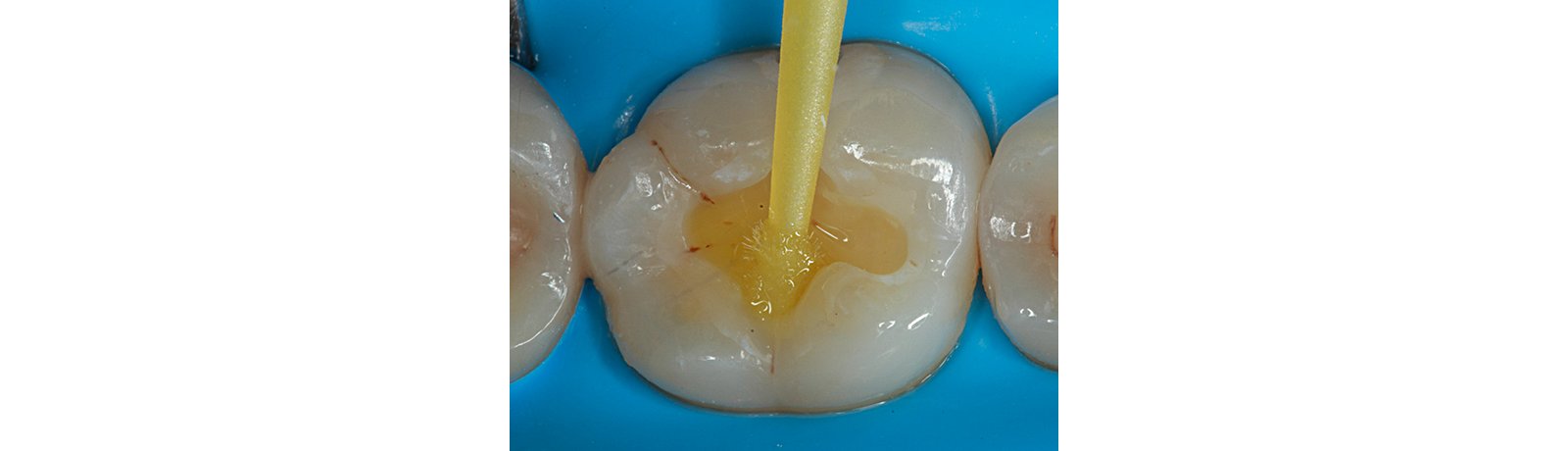 3M Scotchbond Universal Adhesive applied to cavity