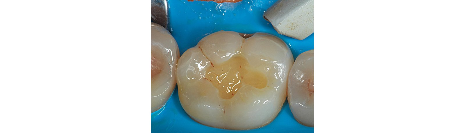 Close up air drying of tooth