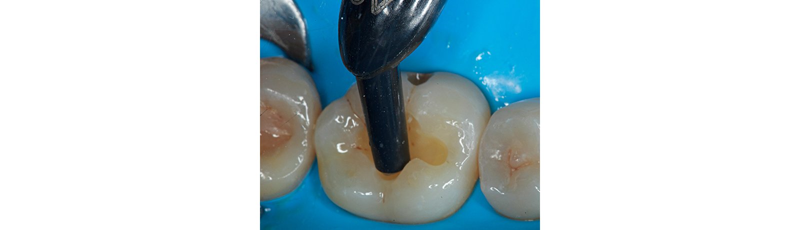 Close up of tooth with 3M filtek bulk fill restorative applied