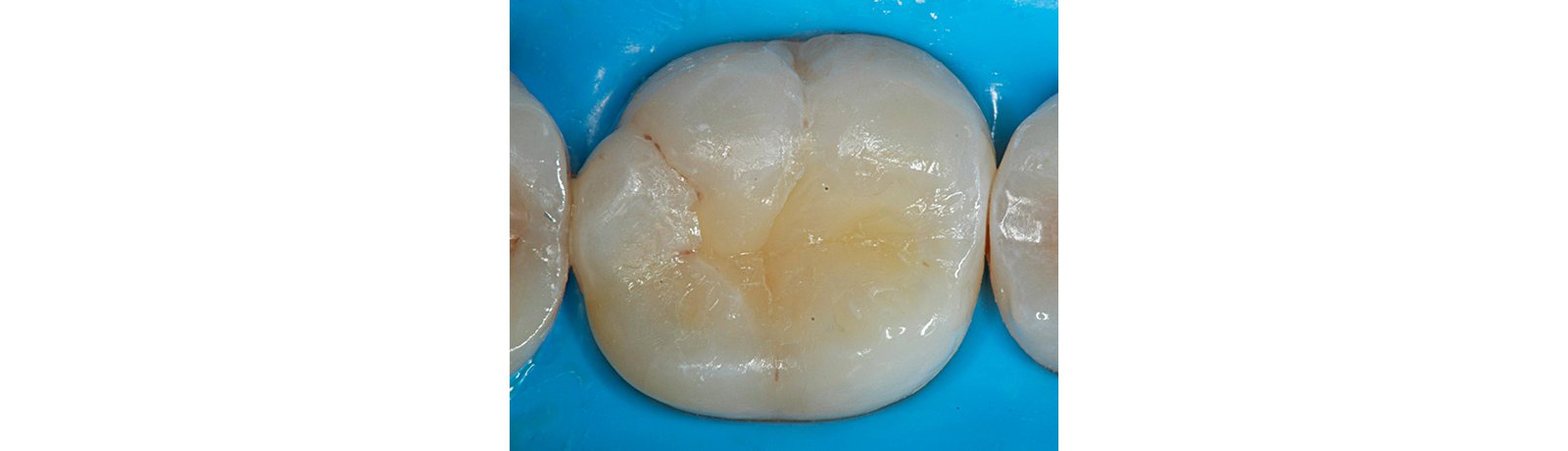 Close up of tooth showing cured application of 3M Filtek One Bulk Fill Restorative