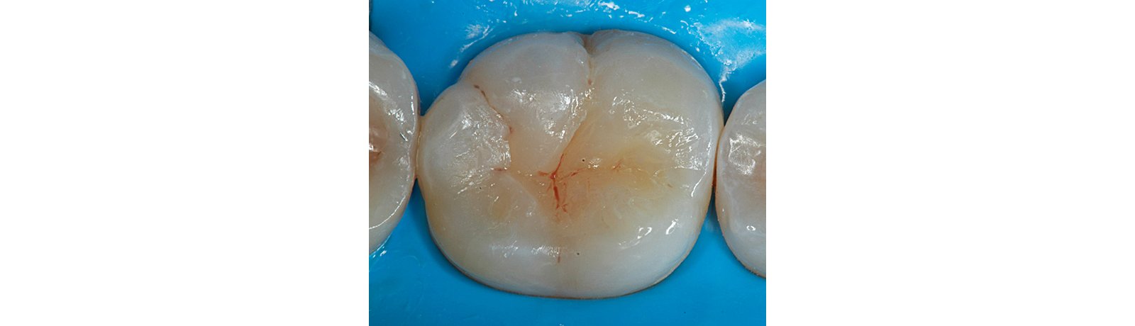 Close up of tooth showing staining resin