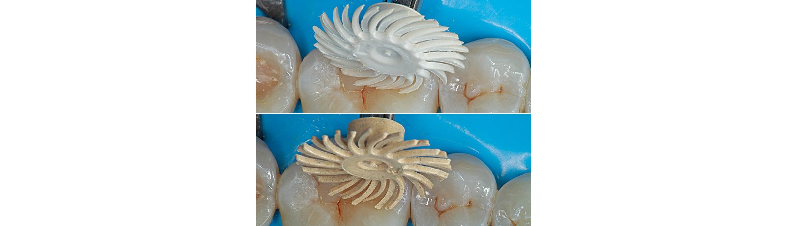 Close up of tooth being finished and polished