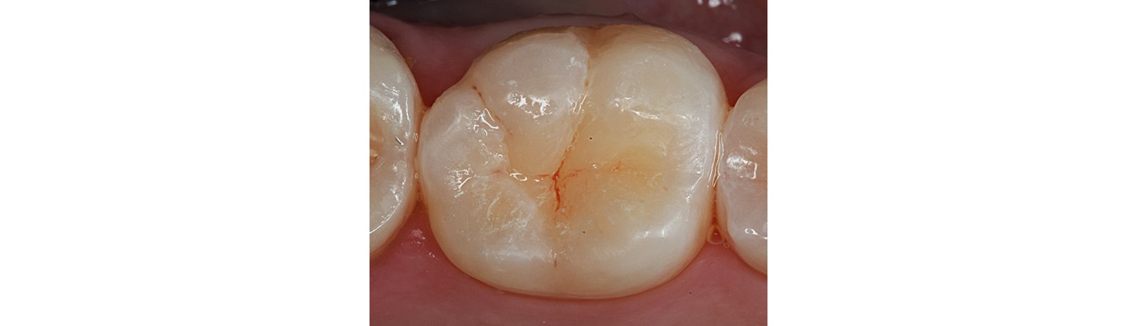 Close up of tooth