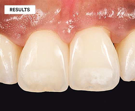 Close up of tooth showing contact points