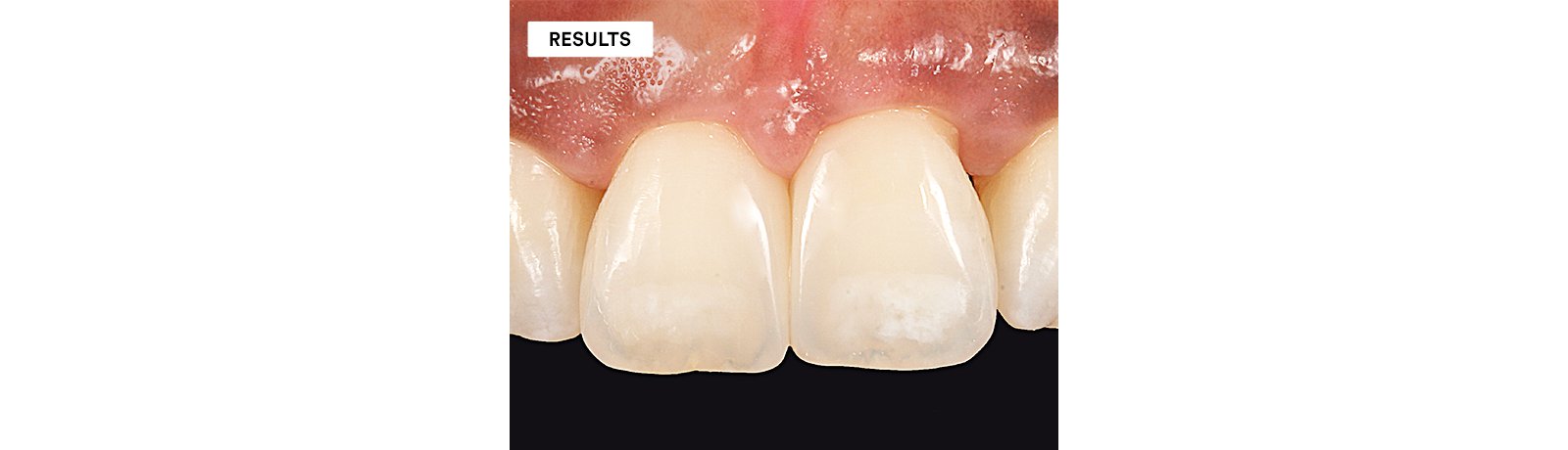 Close up of tooth showing contact points