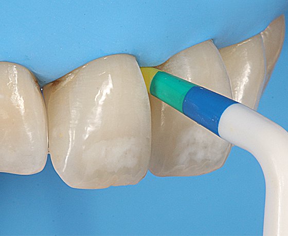 Bioclear© BT Gauge was used to select the correct matrix size