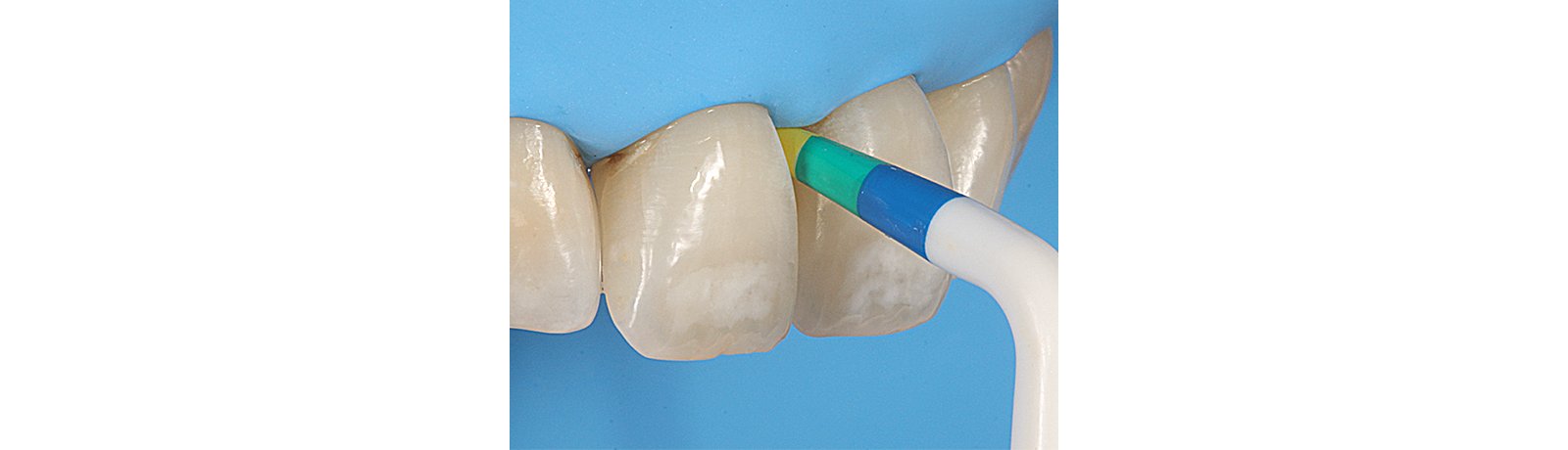 Bioclear© BT Gauge was used to select the correct matrix size
