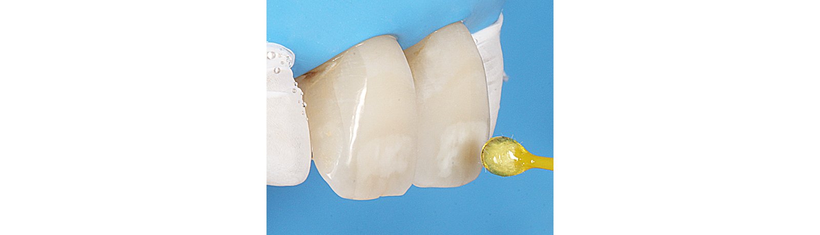 Close up of tooth with 3M filtek bulk fill restorative applied