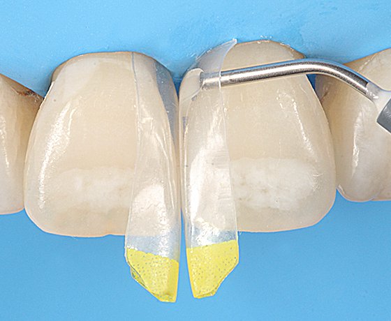 Close up of tooth showing cured application of 3M Filtek One Bulk Fill Restorative