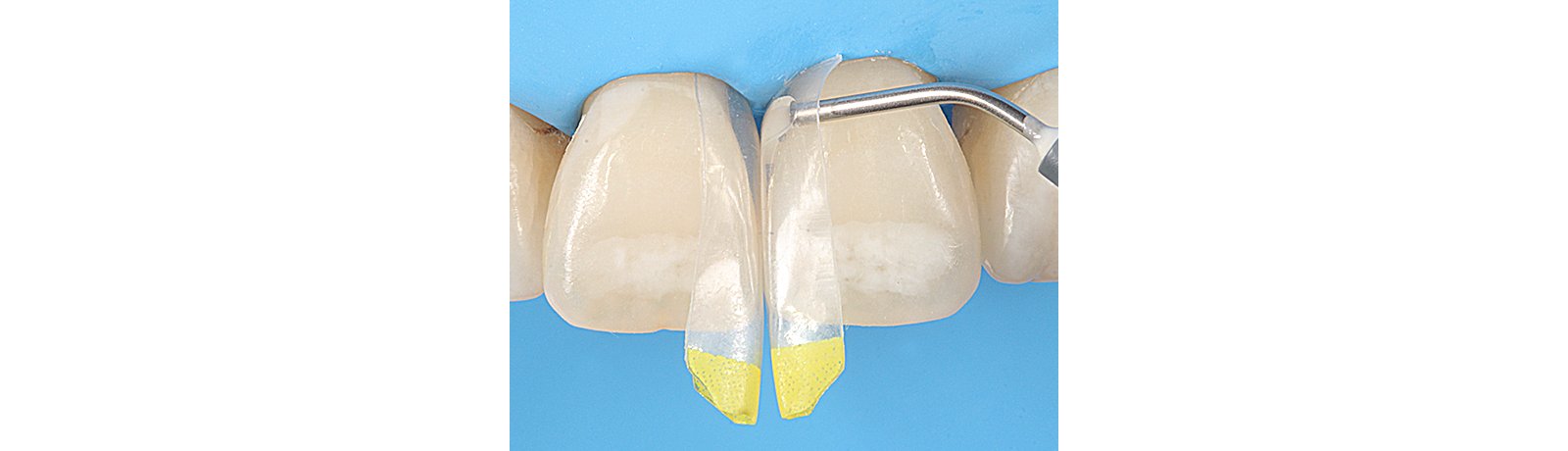 Close up of tooth showing cured application of 3M Filtek One Bulk Fill Restorative