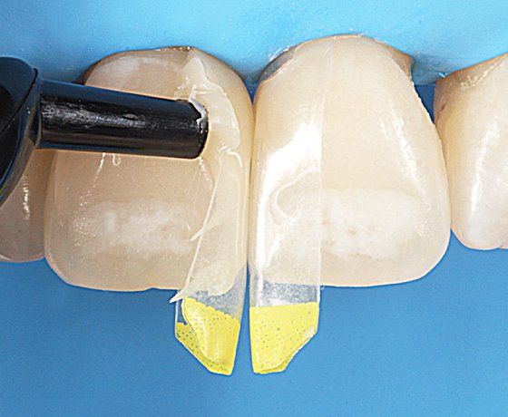 Close up of tooth showing staining resin