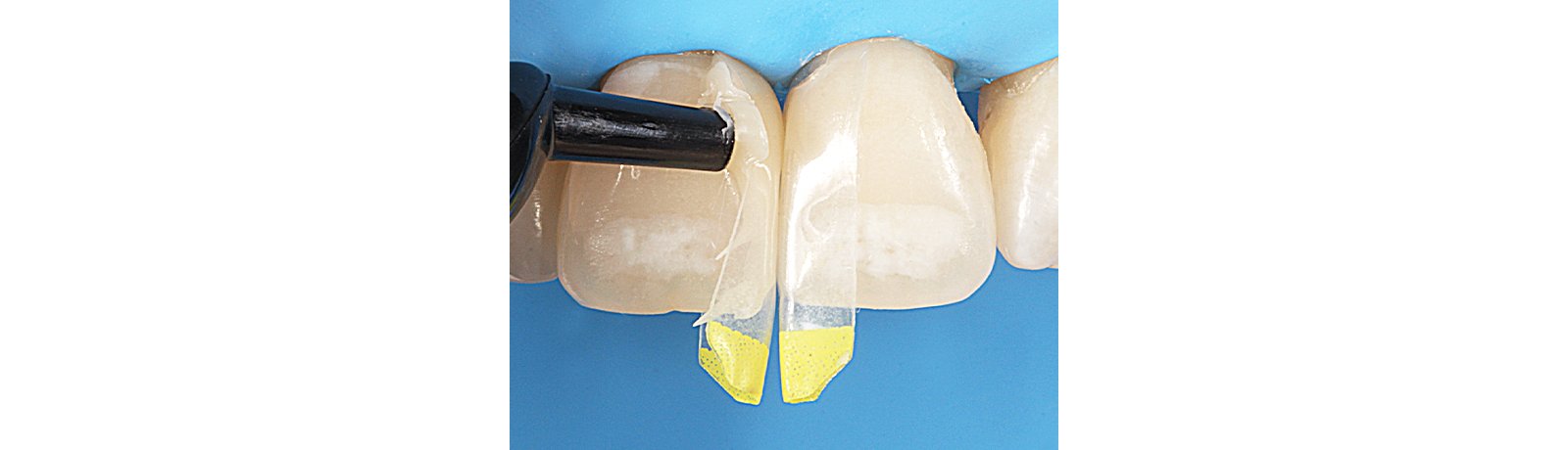 Close up of tooth showing staining resin