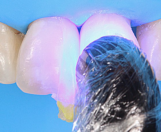 Close up of tooth being finished and polished