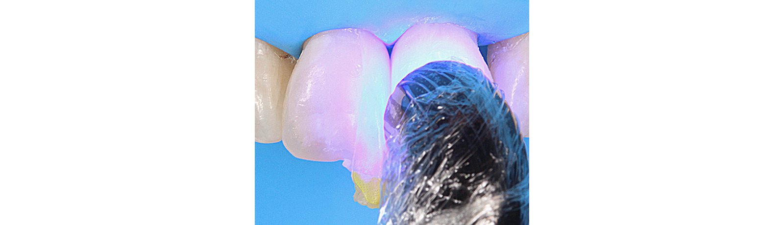 Close up of tooth being finished and polished