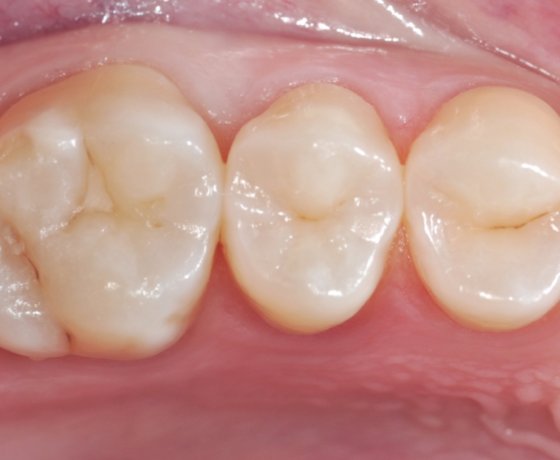 intact occlusal
