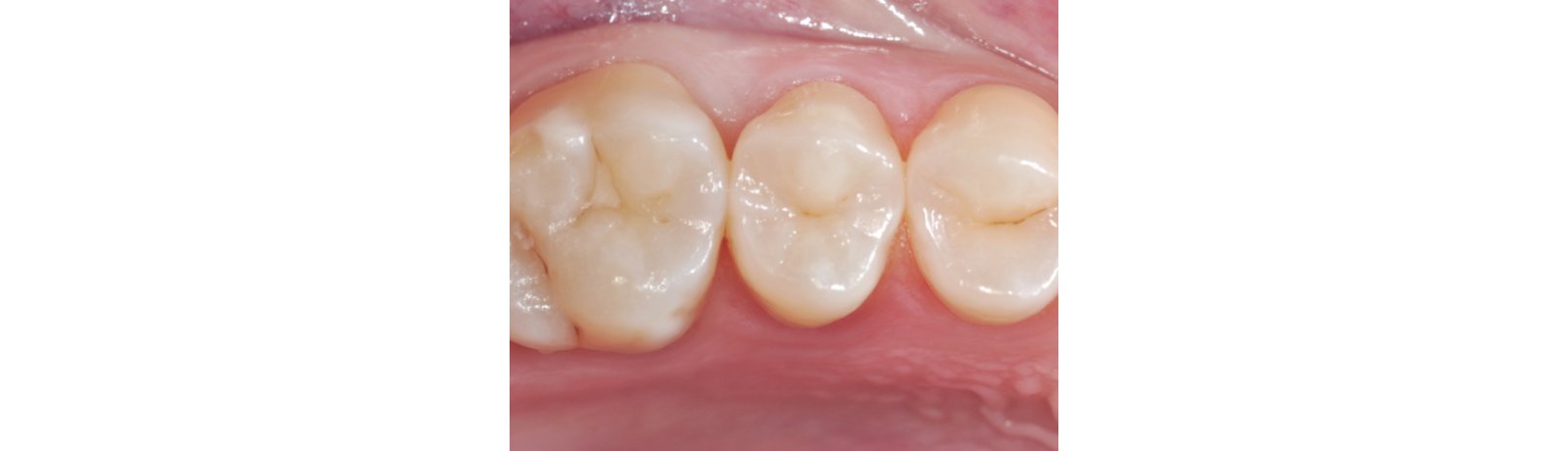 intact occlusal