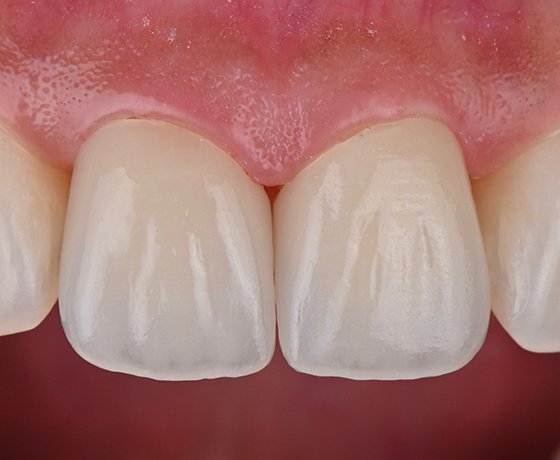 composite