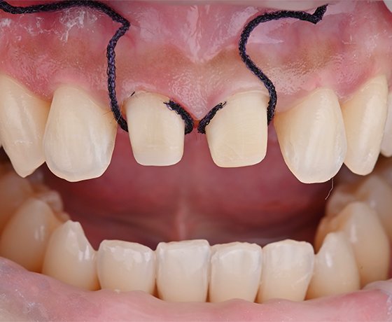 Cord placement after completion of preparations