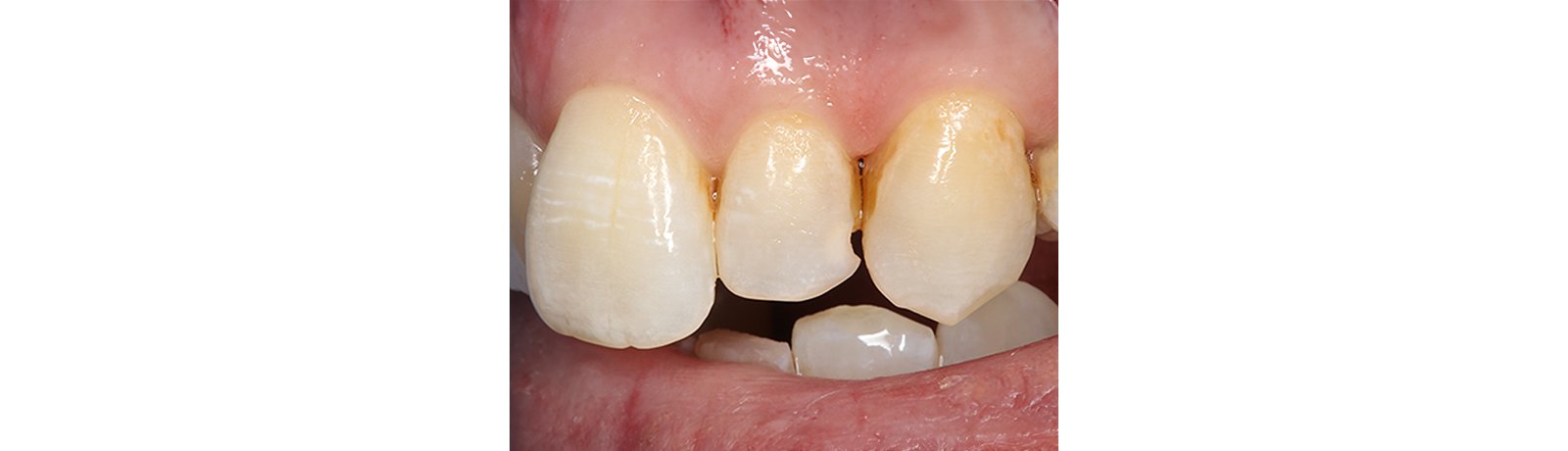 Preoperative.  Monomer degradation, broken and aged restorations