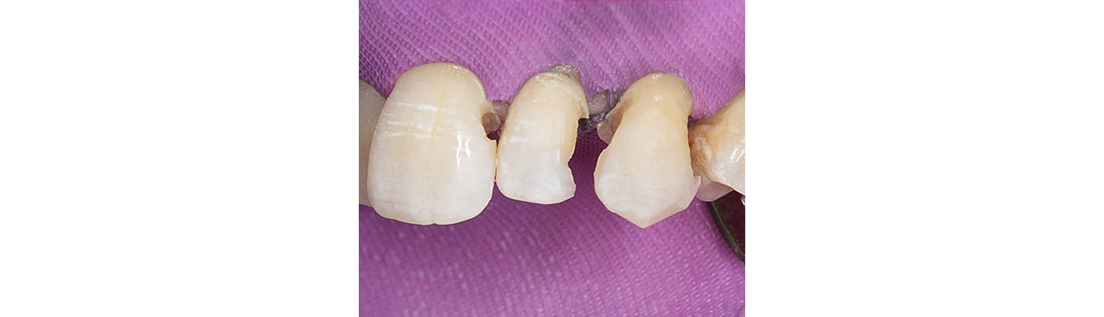 Preparation from the facial. Variable class III restorations with bevels.