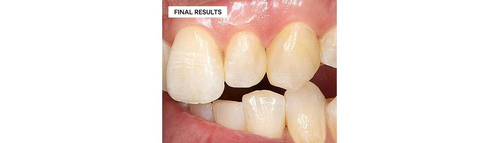 3 week follow up.