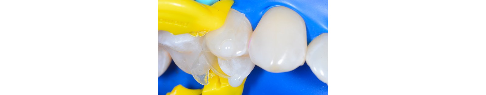 Informative oral care related imagery with a file name of 230310_Herobild_560x400.png shown on Solventum's "Brain Floss" blog