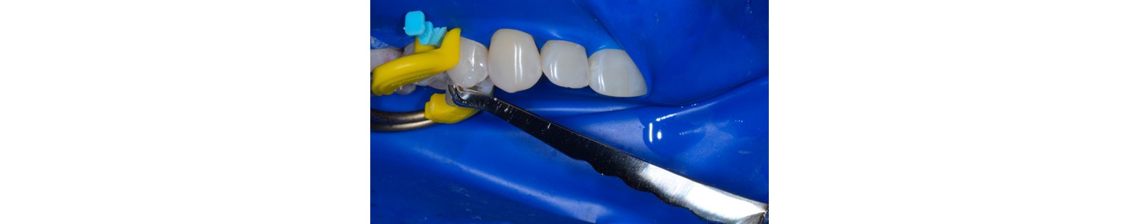Informative oral care related imagery with a file name of 23-10-2023_Blogarticle_2.png shown on Solventum's "Brain Floss" blog