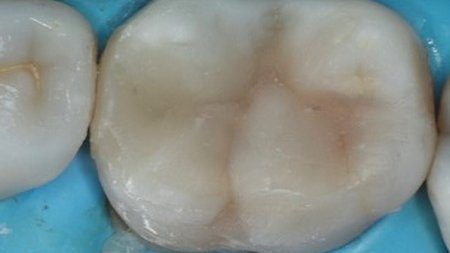 Occlusal view of the restored tooth prior to polishing