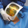 6651EZE IOBAN ANTIMICROBIAL INCISE DRAPE