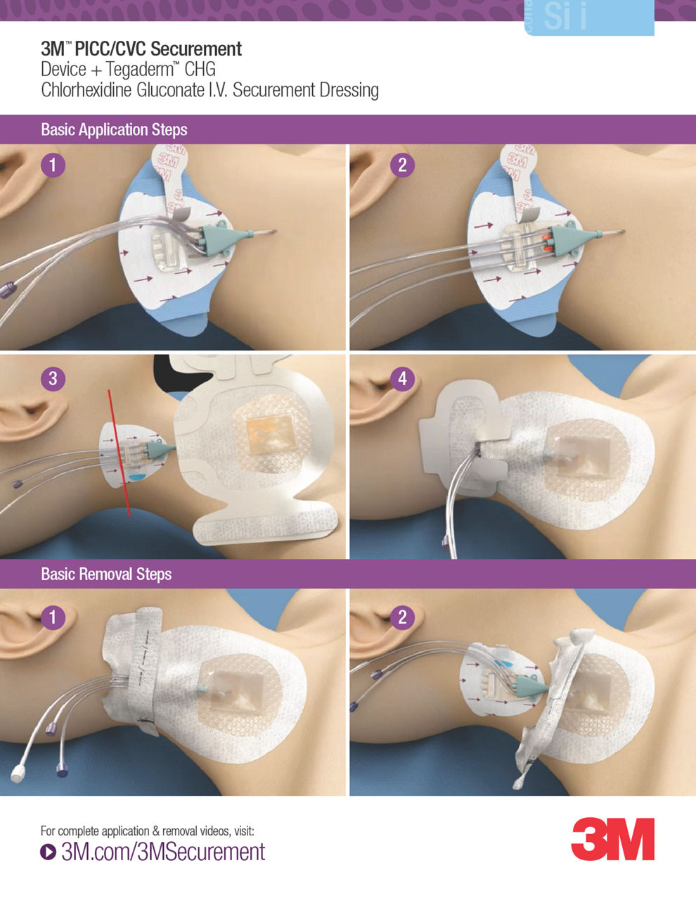 3M™ PICC/CVC Securement