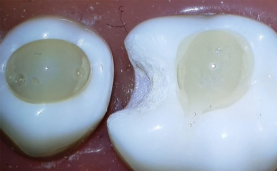 Informative oral care related imagery with a file name of Bonding-comparison-1-850x500-1.png shown on Solventum's "Brain Floss" blog