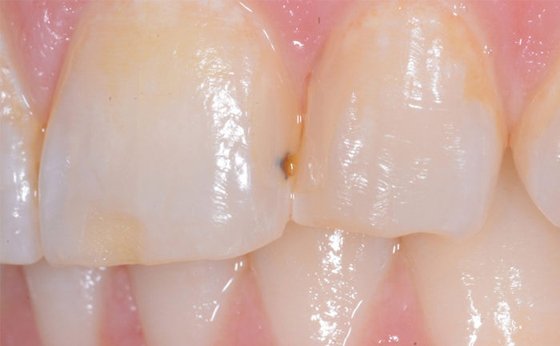 Informative oral care related imagery with a file name of Bonding-smile_before_after_Vargas_850x253.png shown on Solventum's "Brain Floss" blog