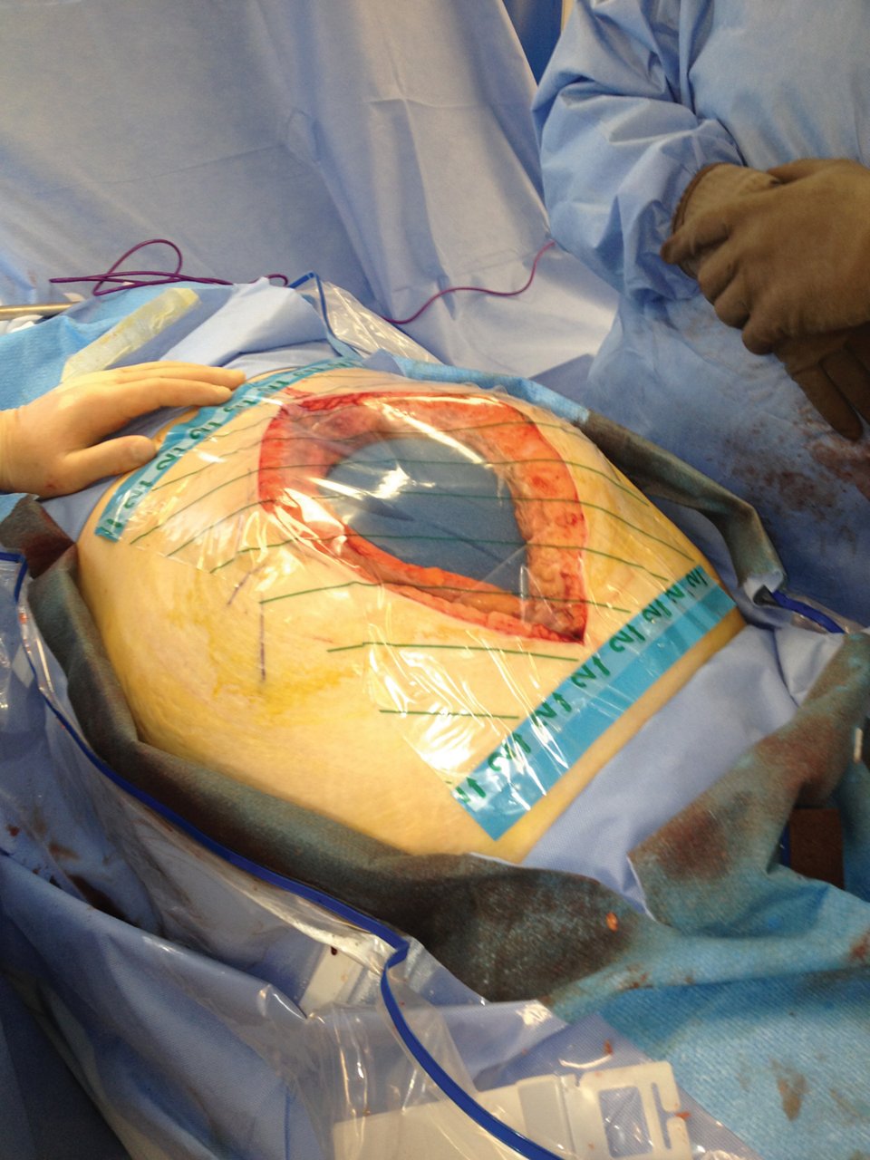 3M™ AbThera™ Terapia de Pressão Negativa para Abdômen Aberto, Aplicação do Filme 3M™ V.A.C.®, Mulher de 75 anos, Pancreatite hemorrágica com ACS, Estudo de Caso, Imagem Clínica, cmyk, jpg, 70-2013-1080-5, PRA-PM-US-03176