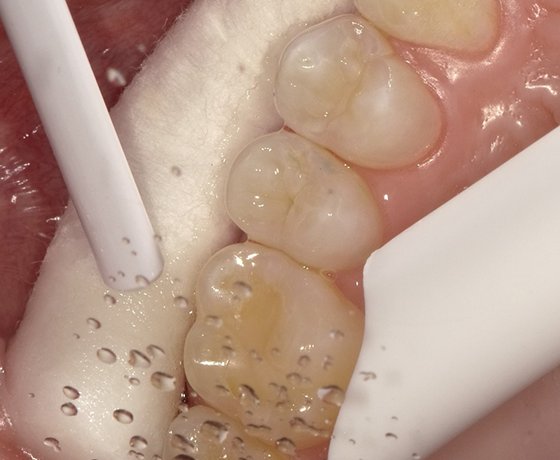 Rinse tooth to remove etchant