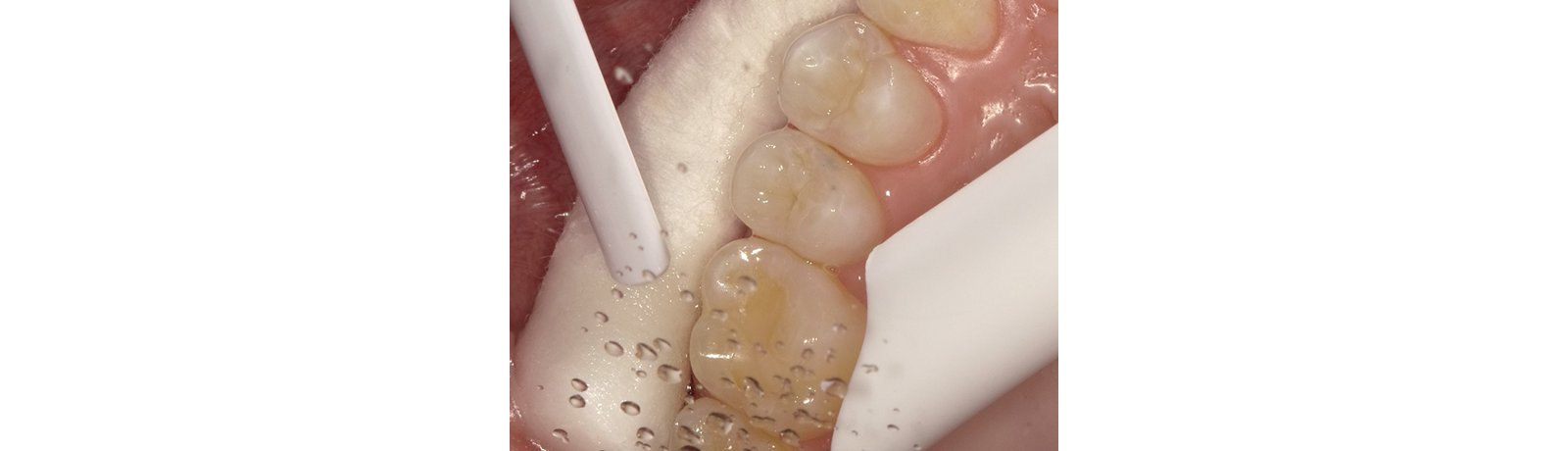 Rinse tooth to remove etchant