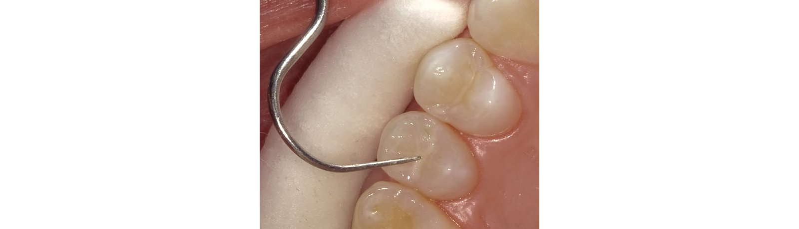 Evaluate sealant
