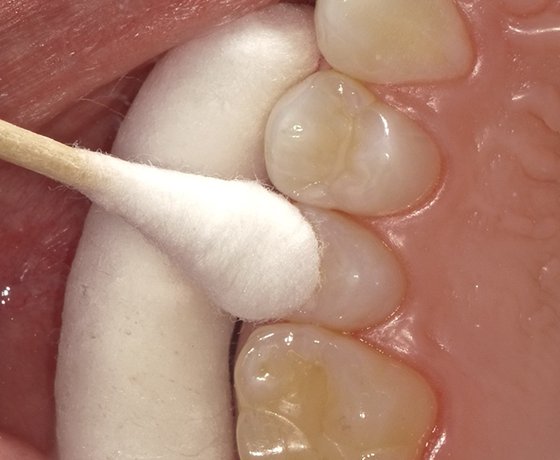 Wipe the sealant to remove the thin film on the surface