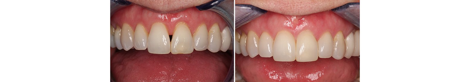 Informative oral care related imagery with a file name of GlassCeramic_Story6.jpg shown on Solventum's "Brain Floss" blog