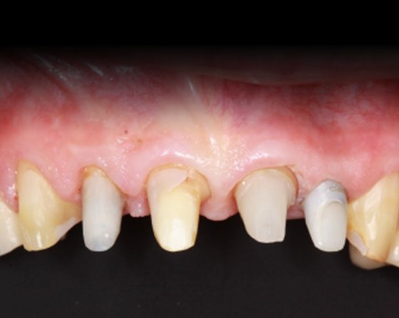 Retraction paste effectively exposed preparation margins and controlled bleeding