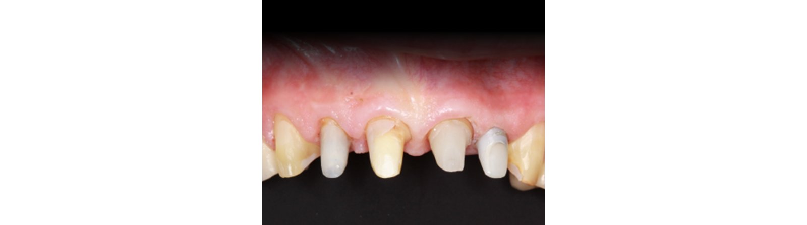Retraction paste effectively exposed preparation margins and controlled bleeding