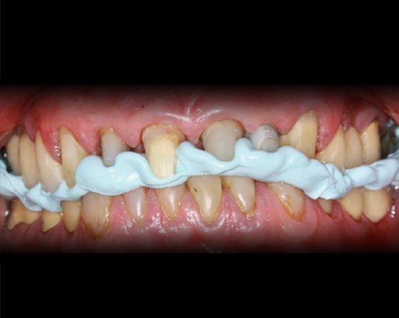 Registration material leads to highly accurate occlusal recording