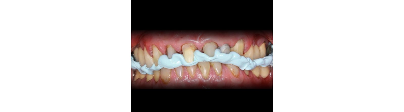 Registration material leads to highly accurate occlusal recording