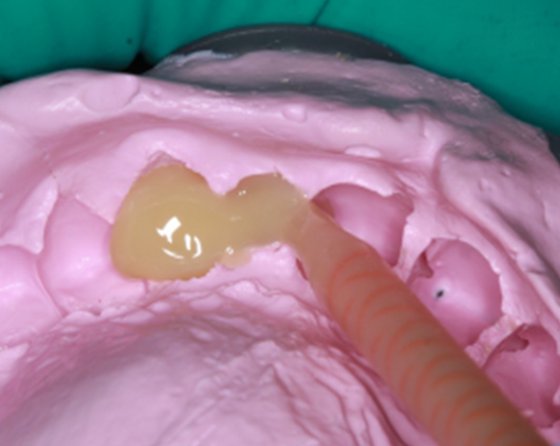 Preliminary impression