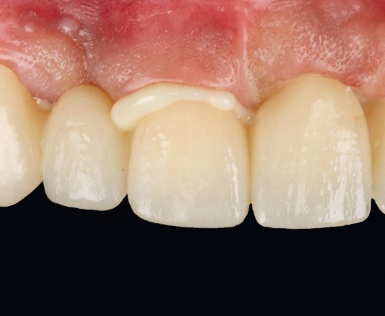 Seated zirconia bridge with cement excess