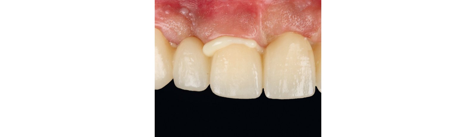 Seated zirconia bridge with cement excess