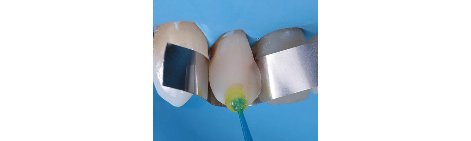 Applied adhesive