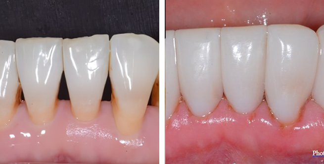 Before and After photo of Bioclear™ Method mandibular restoration