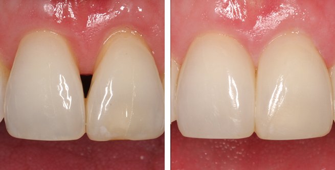 Before and After photo of Bioclear™ Method maxillary restoration