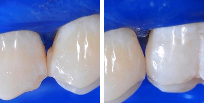 Before and After photo a posterior restoration using the Bioclear™ Method